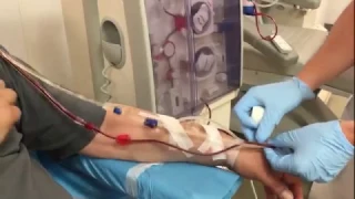 Dialysis : connecting a patient with an arteriovenous fistula