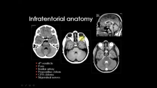 MRI-CT Brain: Infratentorial anatomy