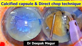 Phaco Basics -Vertical Chop Revisited  - Dr Deepak Megur