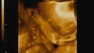 3D-4D Узи Видео - 3D-4D4D Ultrasound Video