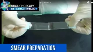 Smear Preparation after Bronchoscopic Needle Aspiration
