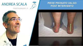 Piede Pronato adulto | Piede pronato valgo post intervento | Dott. Andrea Scala