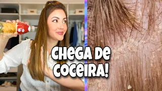 Testei vinagre para tratar dermatite seborreica! Acabei com a coceira e descamação 🤩