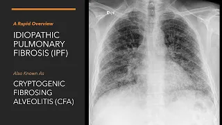 Idiopathic Pumonary Fibrosis | A Rapid Overview | Pathophysiology, Diagnosis & Management of IPF