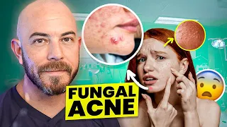 The Best Fungal Acne Treatments Of 2024