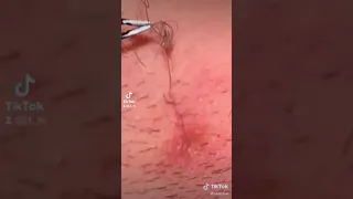 MEGA HAIRBALL INGROWN! #foryoupage #facebook #shorts #fyp #fypシ #youtube #tiktok #viral #foryou