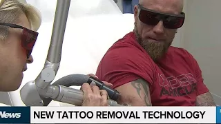 Erasing your ink: new technology helps remove tattoos