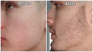 Minoxidil Beard Growth - 3 Month Transformation - BEFORE and AFTER