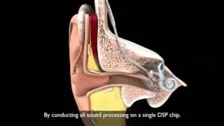 Electro-acoustic implants - how do they work?