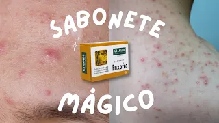 Sabonete de Enxofre: suas perguntas mais frequentes respondidas! Acne | Foliculite | Cravos