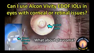 CataractCoach 1075: can I use the Alcon Vivity EDOF IOL in eyes with corneal or retinal issues?