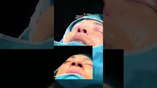 Rhinoplasty || Nose reshaping || Eyelid surgery || Rhinoplasty pakistan || Dr. Hijrat