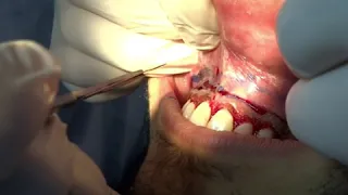 Gingivectomy and lip repositioning