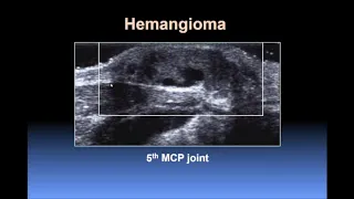 Ultrasound of the Hand and Wrist