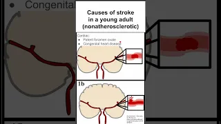 Causes of stroke in a young adult (nonatherosclerotic)