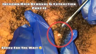 Sorry For The Wait 😮‍💨| Hairy Up’s Ingrown Hair Removal & Extractions Part 17