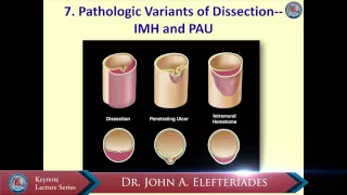 Natural history of Type B aortic dissection: ten tips