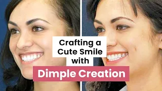 What is Dimple Creation Surgery? | Dimpleplasty | Dimple Creation in Delhi