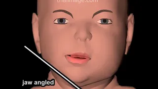 Hemifacial (Craniofacial) Microsomia Animation by Cal Shipley, M.D.