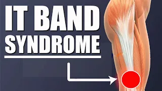 Iliotibial (It) Band Syndrome (Stretches for Hip & Knee Pain l Symptoms l Exercises)