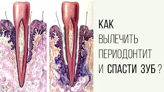 Как вылечить периодонтит и спасти зуб?