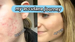 MY ACCUTANE JOURNEY | acne, side effects, results, tips, skincare *everything you need to know*