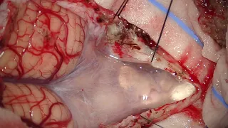 Telovelar approach microsurg resection of 4th ventricular subependymoma arising from rhomboid fossa