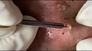 The Most Satisfying Blackhead Removal Technique...Don't Miss Watching It