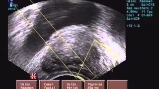 Prostate puncture biopsy