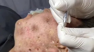 Make your Acne Treatment Huong Da Nang​ | acne 2022 Part17