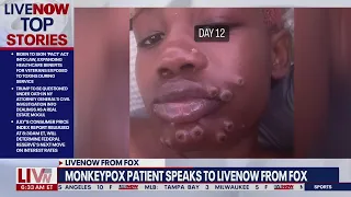 Monkeypox patient contracted virus at Georgia gas station | LiveNOW from FOX