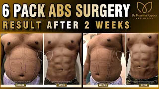 6 pack abs | 4D high definition surgery | Get Abs without Workout