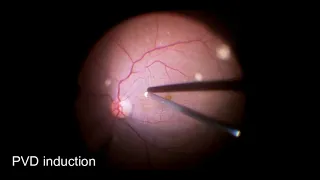 Vitreomacular Traction (VMT) release