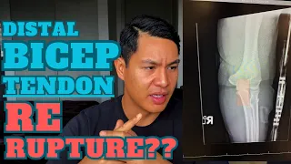 Re-rupture Bicep Tendon?? (Surgical Route) | Distal Bicep Tendon 2023