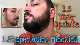 I Stopped Using Minoxidil on my Beard and 1.5 Year Update (18 Months)