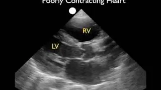 Cardiac Ultrasound - Parasternal Long Axis - Part 2 - SonoSite, Inc.