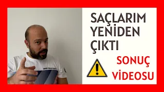 Yeni Video !! Saçlarım Yeniden Çıktı l Saç Çıkaran Mucize Doğal Kür l Saç Dökülmesine Karşı Çözüm