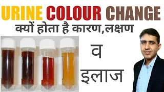 Urine Colour Change क्यों होता है -कारण ,लक्षण व् इलाज |पेशाब का कलर कैसा होना चाहिए |Color Of Urine