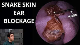 Snake Skin Accordion Ear Blockage