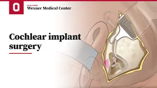 Cochlear implant surgery | Ohio State Medical Center