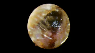 CERAMIC FOREIGN BODY IN EAR & IMPACTED WAX