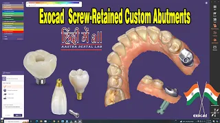 exocad implant design || Screw-Retained Custom Abutments Design in exocad 🦷