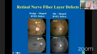 AIOC2021- GP188 - Topic - Dr. M  SHIRAZ ALI -  Evaluation of Optic Nerve Head In Glaucoma