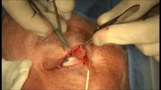 Repair of 50% upper lid defect with a canthotomy/cantholysis