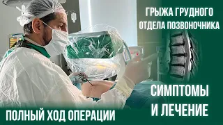 Грыжа грудного отдела позвоночника  Симптомы, тактика, лечение  Эндоскопическая операция