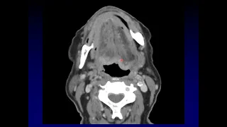 Quick Case - Tongue Base Mass