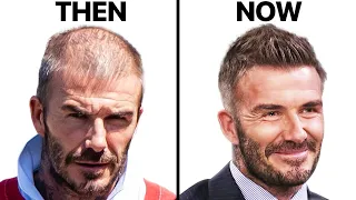 David Beckham: How He Stopped Hair Loss