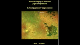 Macular atrophy of the retinal pigment epithelium.