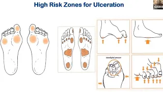 Diabetic Foot Ulcers and Infections