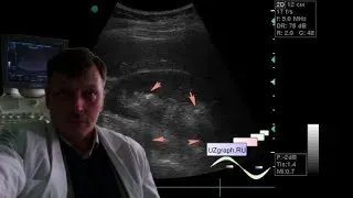 Kidney ultrasound - Lumbar pain (kidney stones)